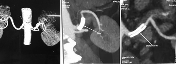 Hình 3. Hình ảnh chụp CT ổ bụng 1 tháng sau khi can thiệp