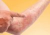Ai mắc bệnh viêm da dị ứng ? bệnh viêm da dị ứng