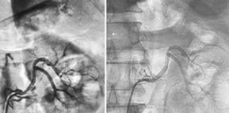 Hình 2. Hình ảnh chụp mạch và đặt stent động mạch thận trái trên