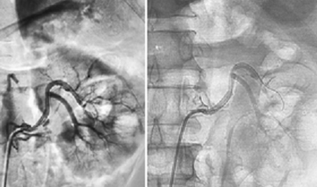 Hình 2. Hình ảnh chụp mạch và đặt stent động mạch thận trái trên