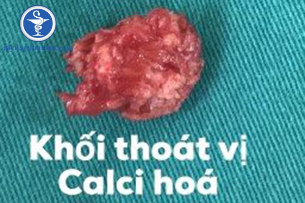 Hình ảnh: Khối thoát vị calci hóa được bóc tách và lấy ra