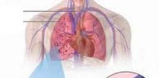 Huyết khối gây tắc động mạch phổi (Ảnh minh họa)