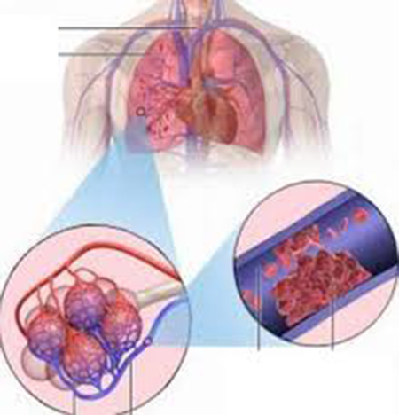 Huyết khối gây tắc động mạch phổi (Ảnh minh họa)