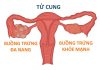 Hội chứng buồng trứng đa nang và những điều cần biết Hội chứng buồng trứng đa nang và những điều cần biết