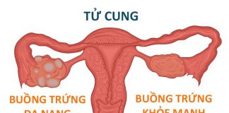 Hội chứng buồng trứng đa nang và những điều cần biết