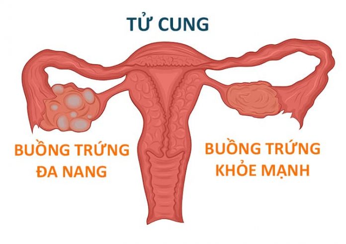 Hội chứng buồng trứng đa nang và những điều cần biết