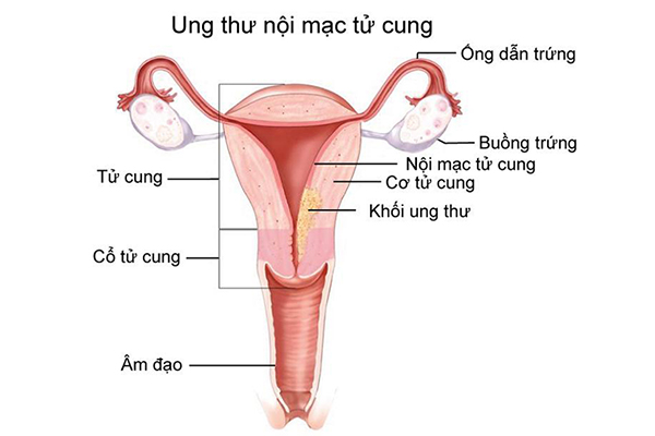 Nguy cơ ung thư nội mạc tử cung thấp hơn so với những phụ nữ chưa bao giờ sử dụng