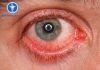 Bệnh viêm kết mạc: Nguyên nhân, triệu chứng và cách điều trị Bệnh viêm kết mạc: Nguyên nhân, triệu chứng và cách điều trị