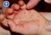 Phòng chống bệnh chân tay miệng Phòng chống bệnh chân tay miệng