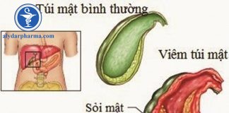 Sỏi mật có nguy hiểm không?