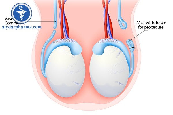 thắt ống dẫn tinh