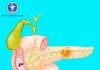Viêm Tụy Cấp – Phác Đồ BV Bạch Mai Viêm Tụy Cấp – Phác Đồ BV Bạch Mai