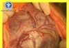Hướng dẫn thực hành lâm sàng dựa trên bằng chứng trường hợp nhau bám bất thường Hướng dẫn thực hành lâm sàng dựa trên bằng chứng trường hợp nhau bám bất thường