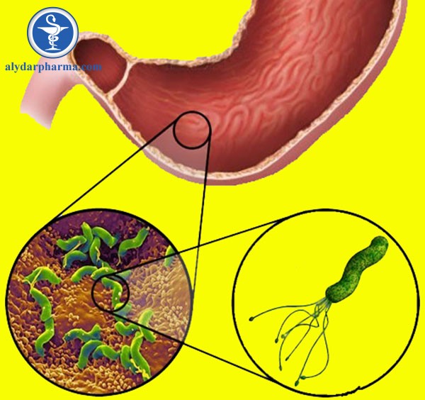 Vi khuẩn H. Pylori là một trong những nguyên nhân gây viêm loét dạ dày