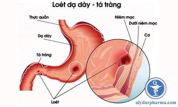 Loét dạ dày tá tràng là tình trạng niêm mạc bị loét do nhiều nguyên nhân