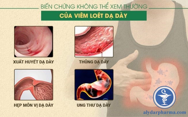 Ung thư dạ dày là một trong những biến chứng nặng nhất