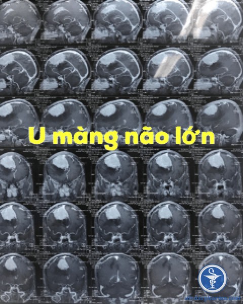 U màng não lớn