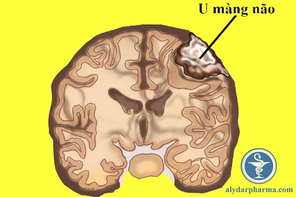 U màng não: phân loại, chẩn đoán và thái độ điều trị
