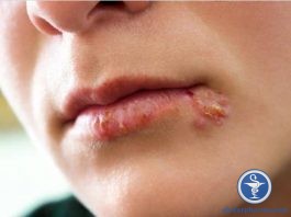 Bị zona thần kinh nên kiêng những gì ?