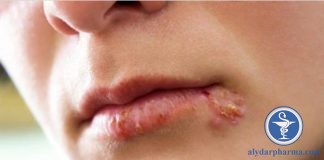 Bị zona thần kinh nên kiêng những gì ?