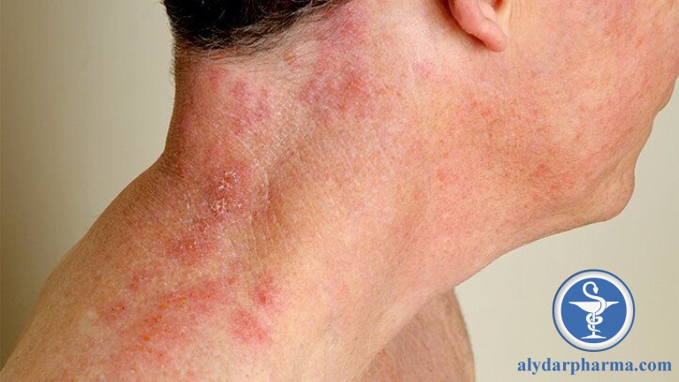 Bệnh zona thần kinh được gây nên bởi Virus varicella-zoster