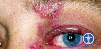 Bị zona thần kinh ở mắt: Tình trạng nguy hiểm cần lưu ý.