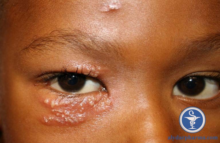 Phát ban zona tại mắt có thể xuất hiện đồng thời với đợt phát ban trên da hoặc vài tuần sau khi mụn nước trên da biến mất.