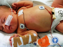 Phòng ngừa Streptococcus nhóm B khởi phát sớm ở trẻ sơ sinh