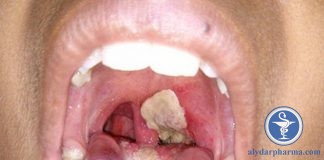 Tìm hiểu bệnh viêm họng giả mạc là gì? Có nguy hiểm không?