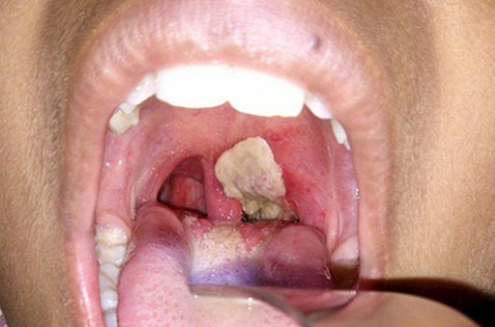 Tìm hiểu bệnh viêm họng giả mạc là gì? Có nguy hiểm không?