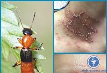 Cần làm gì khi tiếp xúc với kiến ba khoang
