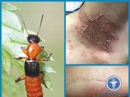 Cần làm gì khi tiếp xúc với kiến ba khoang
