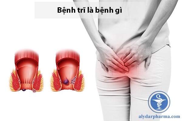 Tìm hiểu chung về bệnh trĩ